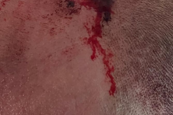 A head injury suffered by a hunt saboteur on the Quantock Hills.
