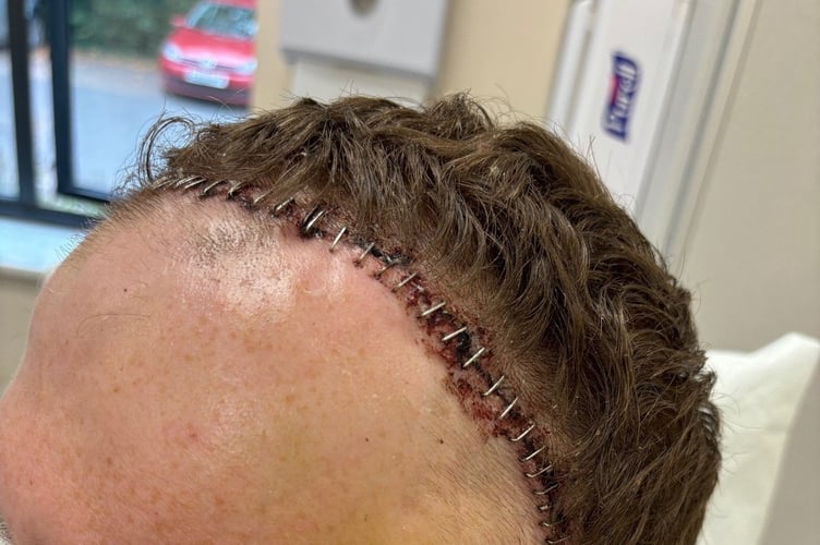 Marcus Williams surgery scar. Photo released February 11 2025. A dad lost all memory of his family and even forgot his own name as a result of an aggressive brain tumour - after being misdiagnosed with vertigo.Marcus Williams, 35, began experiencing intense headaches, fatigue, and seizures but doctors repeatedly misdiagnosed his symptoms for vertigo.The dad-of-one started to lose his memory - and couldn't recognise his daughter, Lola, five - and his wife, Laura, 31, pushed to get a CT scan.It revealed a large tumour and Marcus was rushed for emergency surgery to remove 98% of the mass - after being given hours to live.